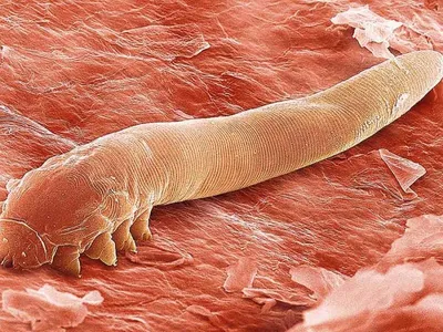 Поедатели человеческой плоти: от ушных червей до цитотоксических пауков
