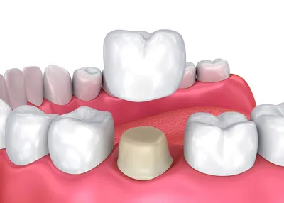 Что лучше – поставить коронку на зуб или реставрировать зуб пломбой? |  Альянс бьюти-ортопедов, Москва