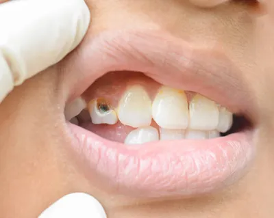 Реставрация зубов в Оренбурге | Восстановление зуба пломбой и коронками |  стоматология Вита-Дент