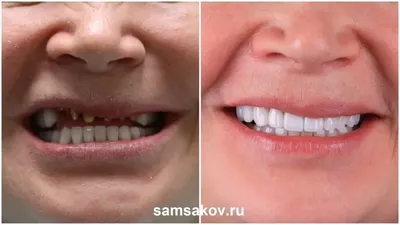 Проблемы, возникающие при протезировании зубов
