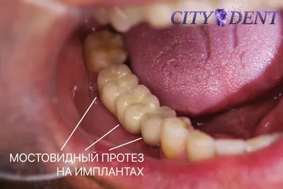 Реставрация зубов в Оренбурге | Восстановление зуба пломбой и коронками |  стоматология Вита-Дент