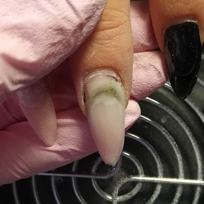 Воспаление ногтя – цены на лечение воспаления ногтя большого пальца на ноге  и руке в Москве | Клиника Полёт