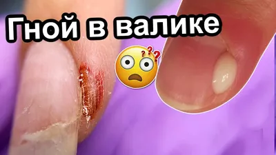 Лечение воспаления ногтевого валика ✓ Авторские статьи Клиники Подологии