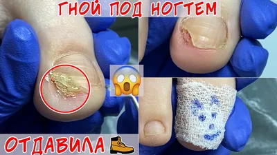 Гной под ногтем 😨 Отдавила ноготь, что делать? - YouTube