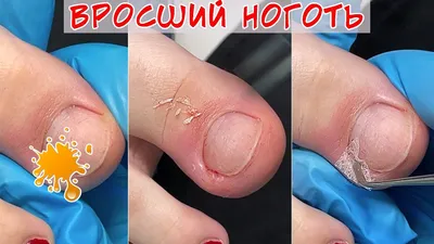 Pus under the nail 😨 Ingrown toenail - YouTube