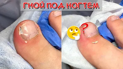 Pus under the nail 😮 Ingrown toenail - YouTube