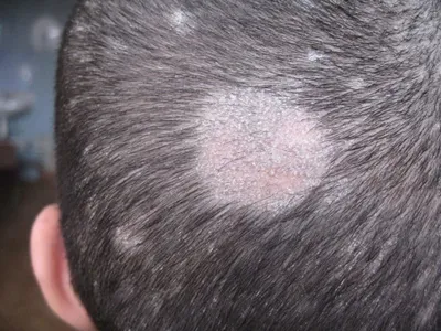 Гнойники на коже головы в волосах – причины и лечение