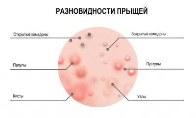 8 признаков того, что на лице не обычные прыщи, а розацеа