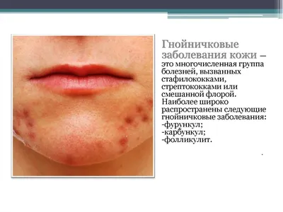Лечение бактериальных инфекций кожи в Санкт-Петербурге