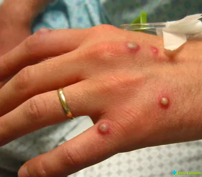 Гнойничковые заболевания кожи – пиодермии