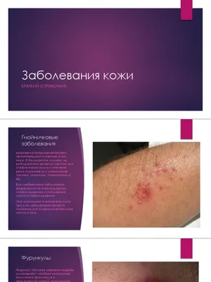Презентация заболевания кожи | PDF