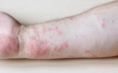 Бактериальные инфекции кожи: какие бывают и как лечить | Бетадин | Дзен