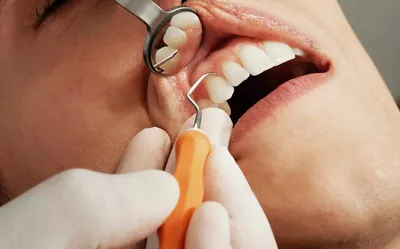 Абсцесс полости рта — острое гнойное воспаление | TopDent | Дзен