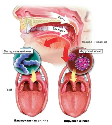 Стоматит: чем лечить, симптомы возникновения язвочек на десне у взрослых,  препараты, лечение стоматологом