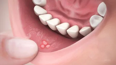 Сверхкомплектные зубы - что это, гипердонтия, причины, лечение  сверхкомплектных зубов