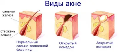 Что такое прыщи на лобке у мужчины: как вылечить, причины, симптомы,  профилактика, консультация врача, последствия