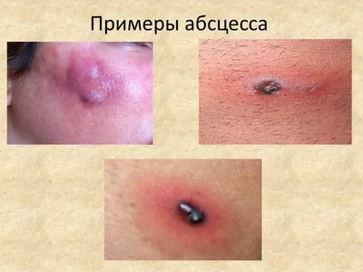 Гнойные заболевания кожи Векторное изображение ©Artemida-psy 186664094