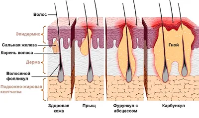 Гнойные заболевания кожи и подкожной клетчатки (фурункул, карбункул,  гидраденит, абсцесс, флегмона) - презентация онлайн