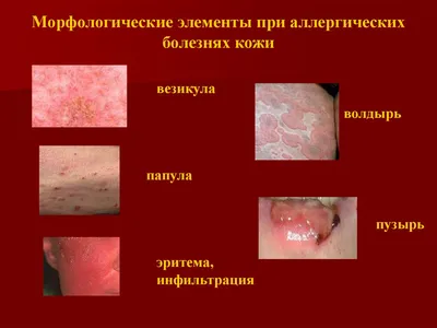 Гнойничковые болезни кожи: как их избежать? — Здоров-Инфо