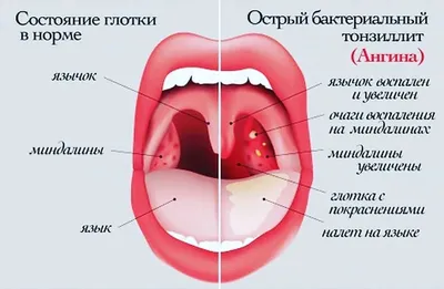 AnnaMama - Про ангину Воспаление небных миндалин и слизистой глотки:  тонзиллит (ангина), фарингит-основная причина боли в горле. Возбудители  ангины-бактерии, вирусы, грибы и др. 1️. Наиболее частые  возбудители-вирусы: антибиотики не нужны проходит ...