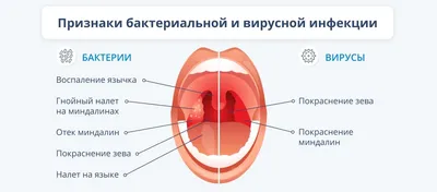 Что такое абсцесс горла, как его распознать и вылечить