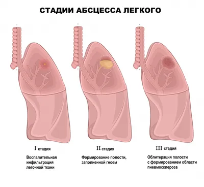 Лечение ангины гомеопатией / Центр Гомеопатии / Статьи