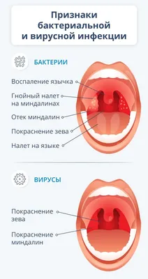 Тонзиллит у детей - причины, симптомы, лечение в клинике «Будь Здоров»