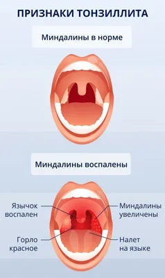 Гнойная ангина: причины, симптомы, заразна ли, осложнения, что делать при  остром тонзиллите