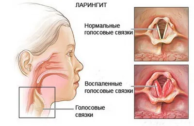 Заглоточный абсцесс – как распознать, вылечить и не допустить | Беттертон