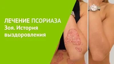 Псориаз | причины, лечение, симптомы, диагностика и профилактика заболевания