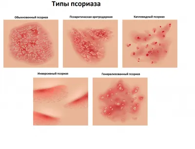 Эффективность ингибитора IL-17А при генерализованном пустулёзном псориазе:  клинический случай - Олисова - Российский журнал кожных и венерических  болезней