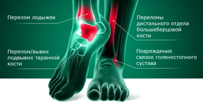 Артроз голеностопного сустава. Лечение в Германии.