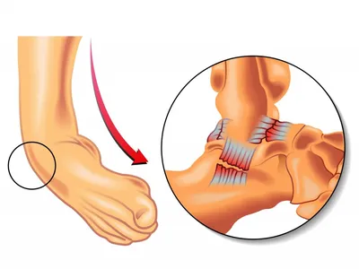Артроз голеностопного сустава – причины, симптомы, диагностика, лечение и  профилактика болезни в клинике «Будь Здоров»