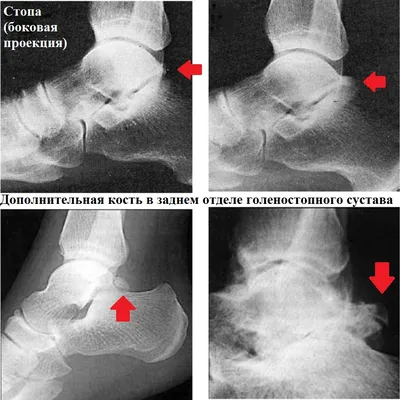 РЕНТГЕН-АНАТОМИЯ ГОЛЕНОСТОПНОГО СУСТАВА - YouTube