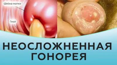 Гонорея, инфекция, лекарственный спрей для снятия сифилиса, баланита,  красноватости, воспаления, генитальной инфекции, лечение с использованием  STD, удаление запаха | AliExpress