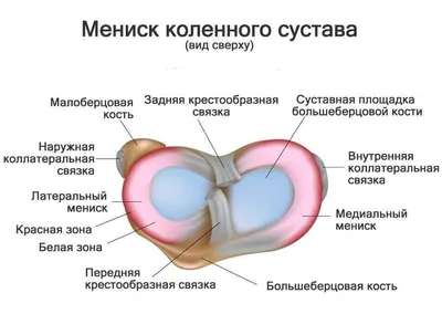 Горизонтальный разрыв заднего рога медиального мениска фото фото