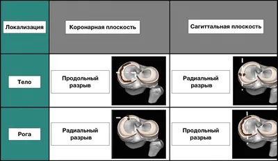 Разрыв мениска - признаки, причины, симптомы, лечение и профилактика -  iDoctor.kz