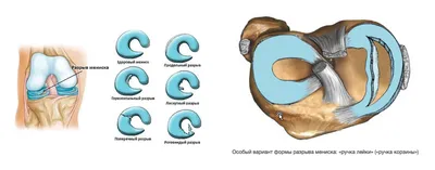 Повреждение мениска коленного сустава | CROSSFIT.RU | Дзен