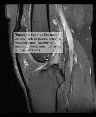 Разрыв мениска коленного сустава - симптомы, диагностика и как лечить