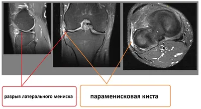 Тренировки при повреждении мениска | Hills Фитнес-клуб | Дзен