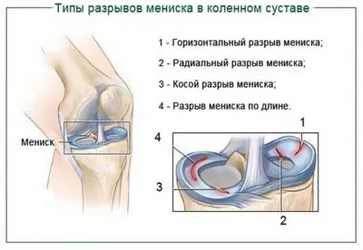 МРТ-диагностика разрывов менисков коленного сустава