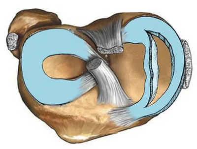 Разрыв мениска коленного сустава - симптомы, лечение разрыва заднего рога  медиального мениска