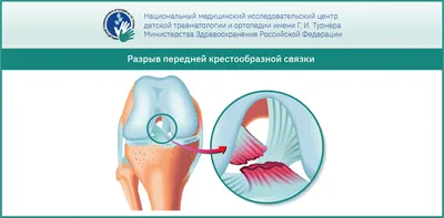 Повреждение (разрыв) мениска коленного сустава: симптомы и лечение,  причины, диагностика и профилактика. | Дмитрий | Дзен