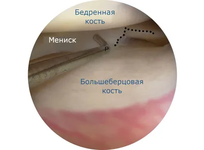 Повреждение заднего рога медиального мениска - статьи клиники Доктора  Глазкова в Москве
