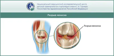 Повреждения коленного сустава: травмы мениска, повреждения ПКС у детей и  подростков