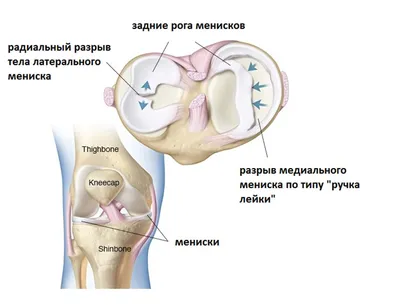 Классификации разрывов мениска — 24Radiology.ru