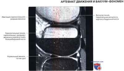 МРТ коленного сустава в Новосибирске – цены в клинике «МРТ Альянс»