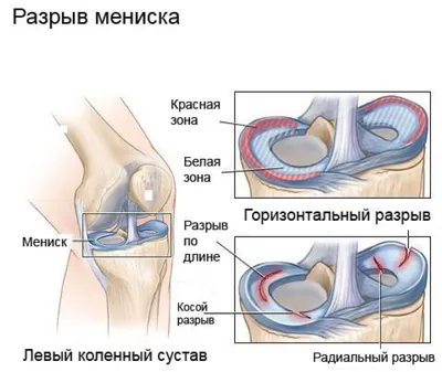 Операция при разрыве мениска | Фото до и после, операция, отзывы, лечение,  реабилитация и восстановление