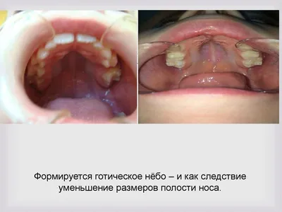 Целесообразность междисциплинарного подхода к ведению пациентов с  недифференцированной дисплазией соединительной ткани в стоматологии uMEDp