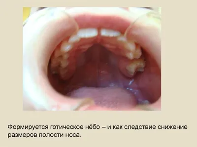 Стоматолог-ортодонт Минск on Instagram: \"Готическое нёбо! 🤔 ⠀ Поверьте,  ничего общего с названием средневековой эпохи в искусстве. Это напрямую  связано с ротовым дыханием❗❗ ⠀ К сожалению, проблемы с аденоидами,  хроническими ринитами, гайморитами